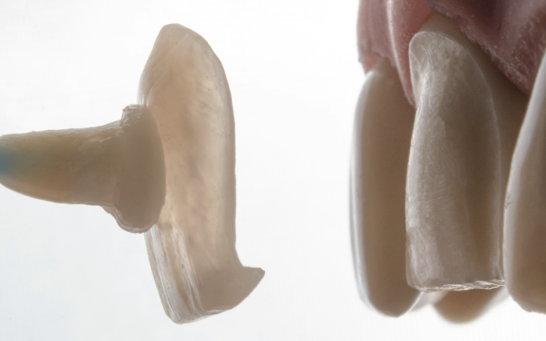 Does Insurance Cover Veneers? What You Need to Know